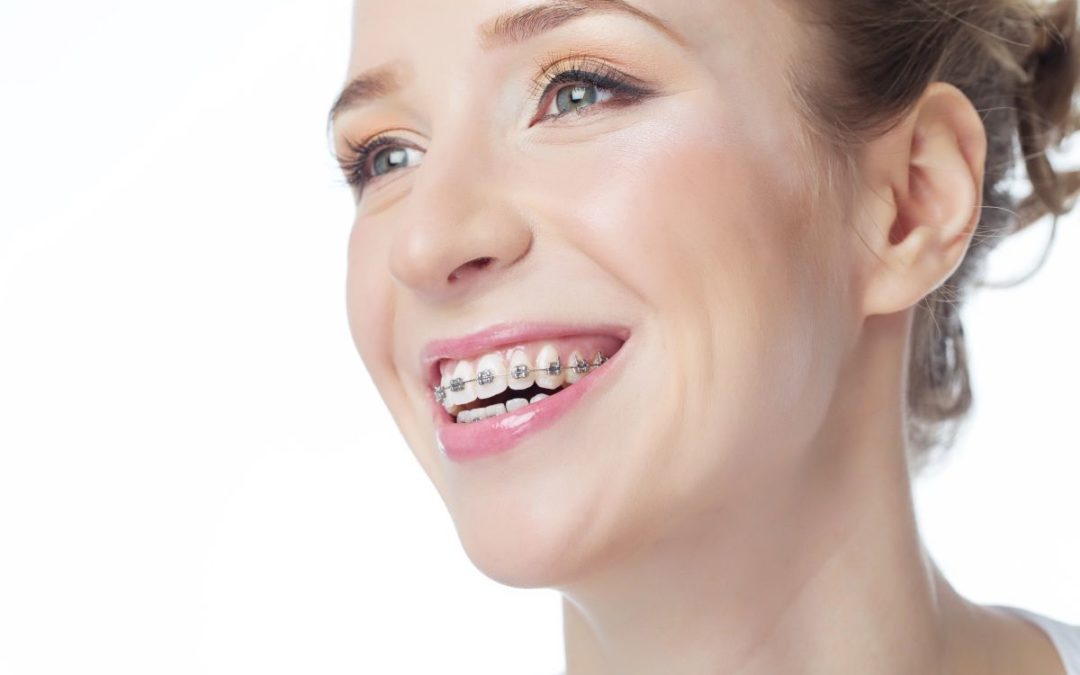 How Braces Can Impact Your New Year’s Resolutions
